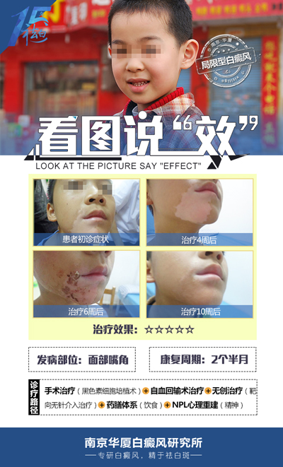 小孩脸上有白斑怎么办 小孩脸上有白斑怎么办